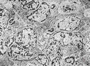 M,2y. | nephroblastoma (Wilms tumor) M,2y. | nephroblastoma (Wilms tumor)